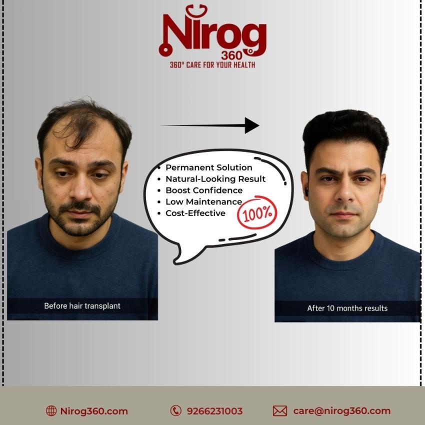 Best Hair Transplant in India – Restore Your Confidence with Nirog 360