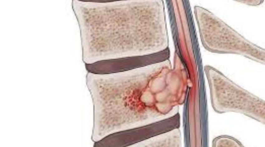 Spine Tumors in Kolkata: Symptoms, Diagnosis and Treatment Options