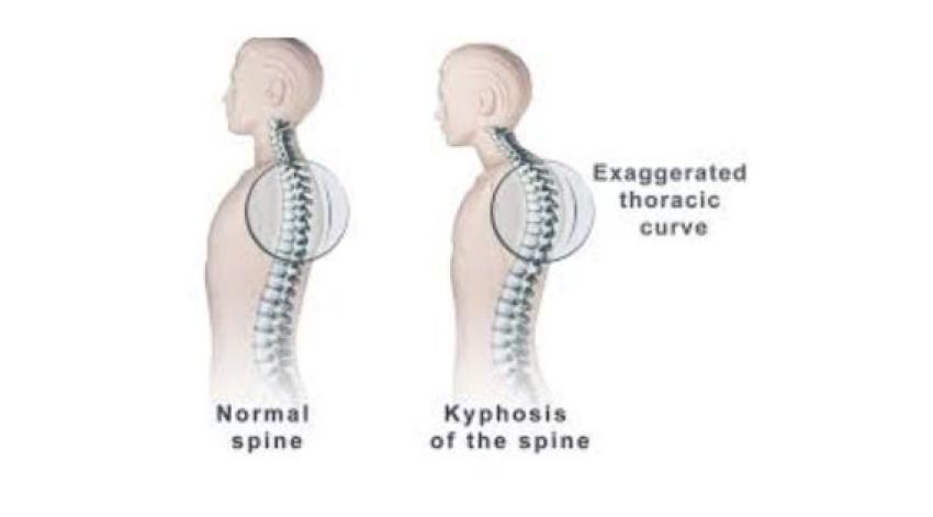 Spinal Deformity Correction in Kolkata: Expertise of Leading Spine Surgeons