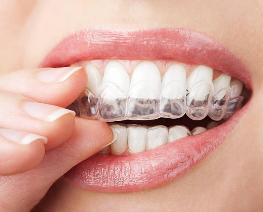 A Clear Path to Confidence: Discover the Benefits of Simpsonville Invisalign