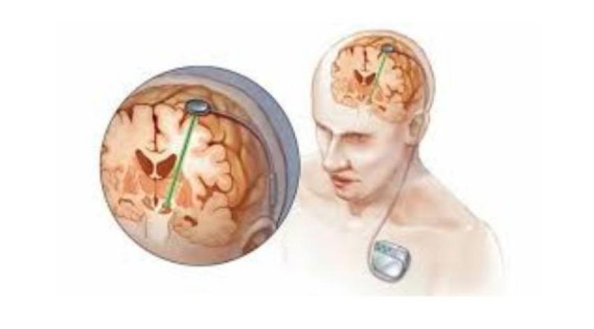 Revolutionizing Parkinsons’ Treatment: DBS Surgery in Kolkata with Top Neurosurgeons