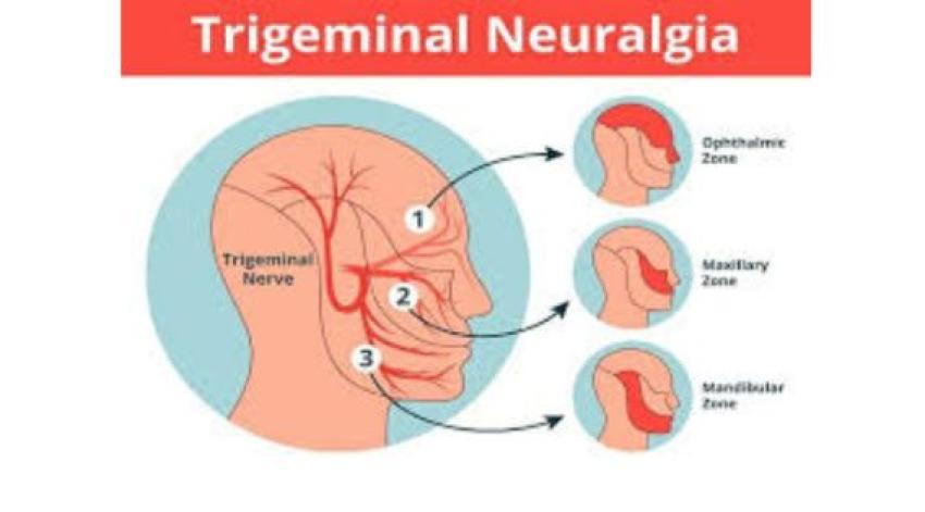 Effective Trigeminal Neuralgia Treatment in Kolkata: Compassionate Care, Modern Solutions
