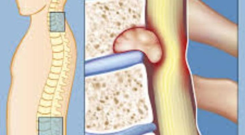 Spine Tumor Diagnosis and Treatment in Kolkata: A Comprehensive Guide