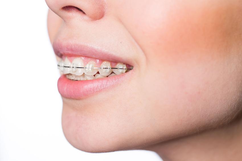 How Bad Does an Overbite Have to Be to Get Braces?