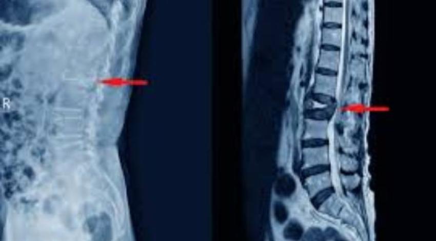 Osteoporotic Vertebral Fractures: How India’s Top Spine Surgeons Are Making a Difference