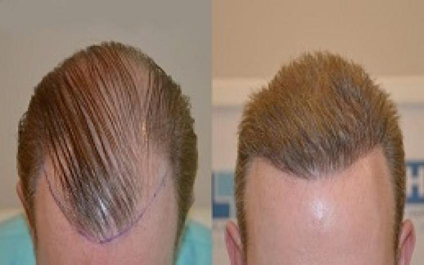 استعد شبابك: كل ما يخص تكلفة زراعة الشعر في دبي