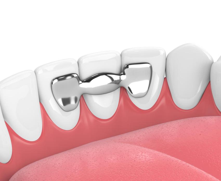 Best Dental Bridges in DHA Lahore for Strong and Natural Tooth Replacement