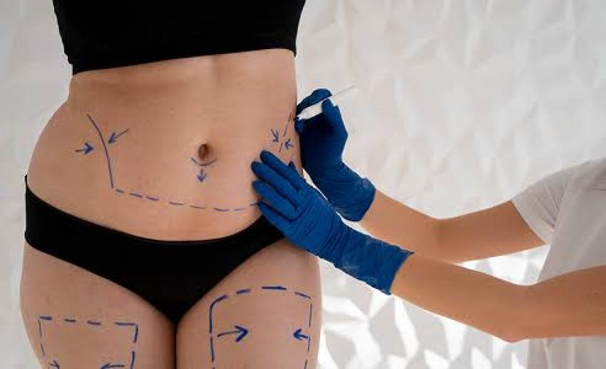 Expert Tummy Tuck in Dubai for a Flatter Shape