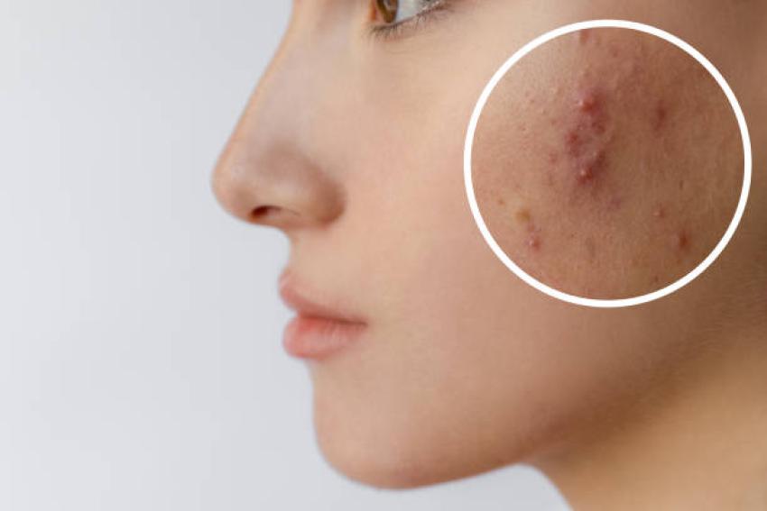 Acne Treatment Mistakes That Make Breakouts Worse