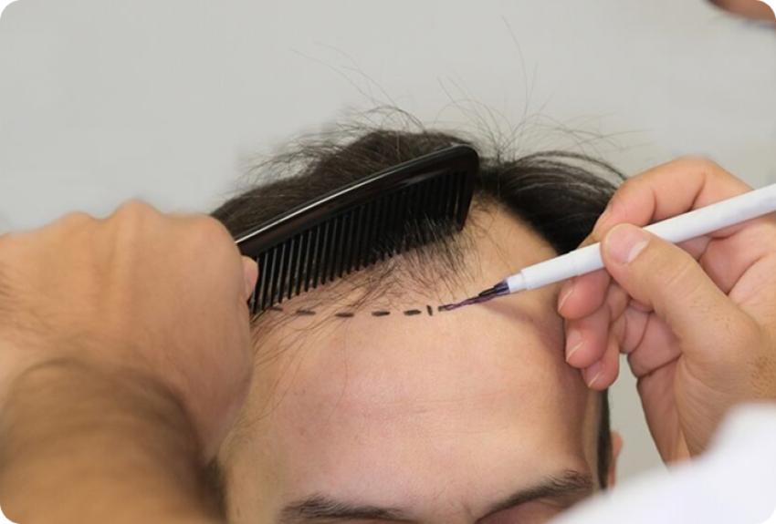 Hair Transplant in Dubai: Who Is a Good Candidate?