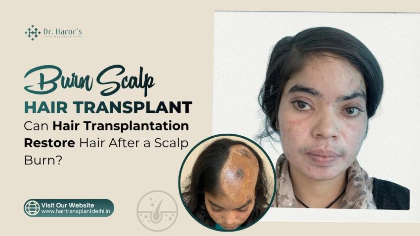 Burn Scalp Hair Transplant: Can Hair Transplantation Restore Hair After a Scalp Burn?