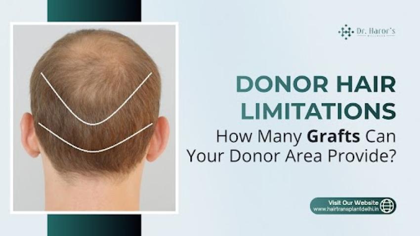 Donor Hair Limitations: How Many Grafts Can Your Donor Area Provide?
