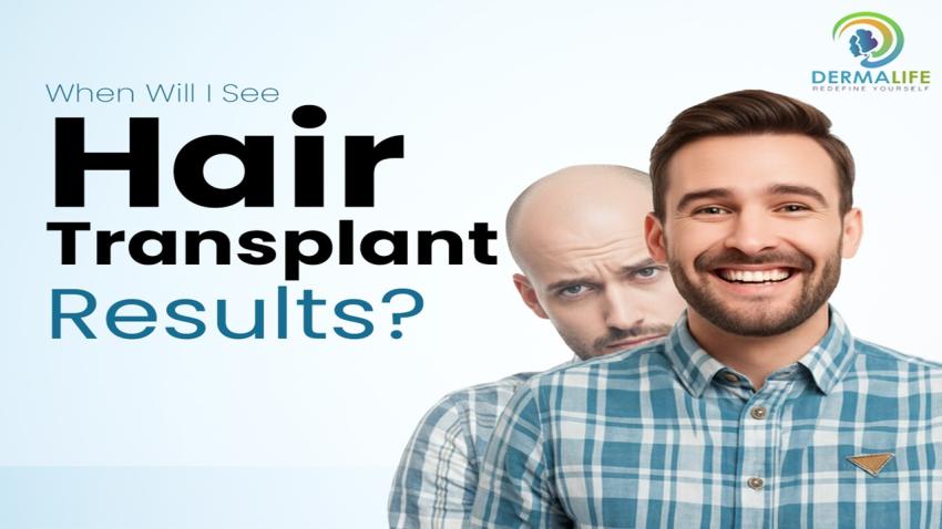 Natural-Looking Hair Transplant: How Hairline Design, Graft Planning and Donor